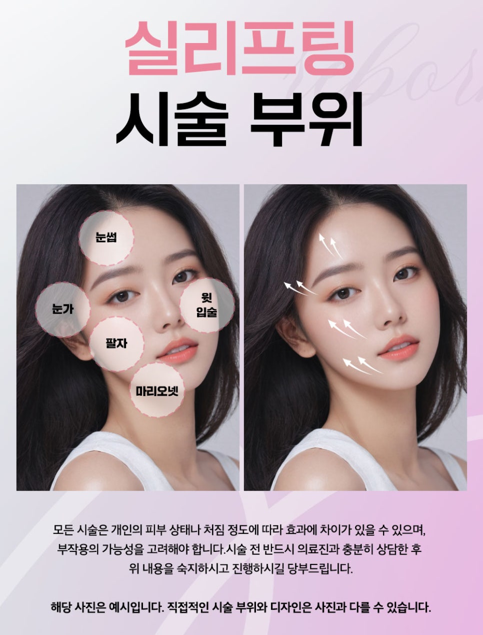 How Can Marionette Line Lifting Improve Sagging Corners of the Mouth? image 4