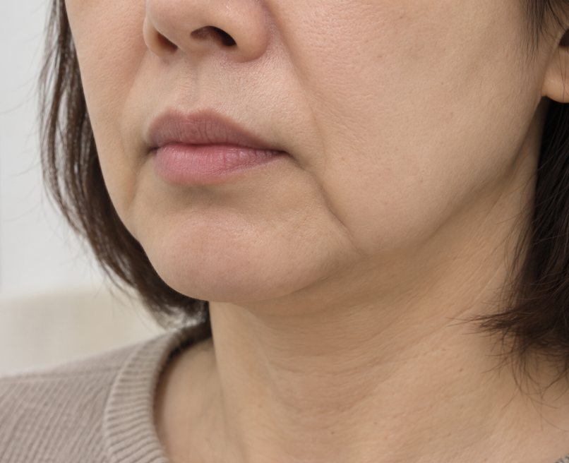 마리오네트 주름 예방하는 방법 있을까? 이미 깊어졌을 때 실리프팅 효과는? 관련 이미지 1