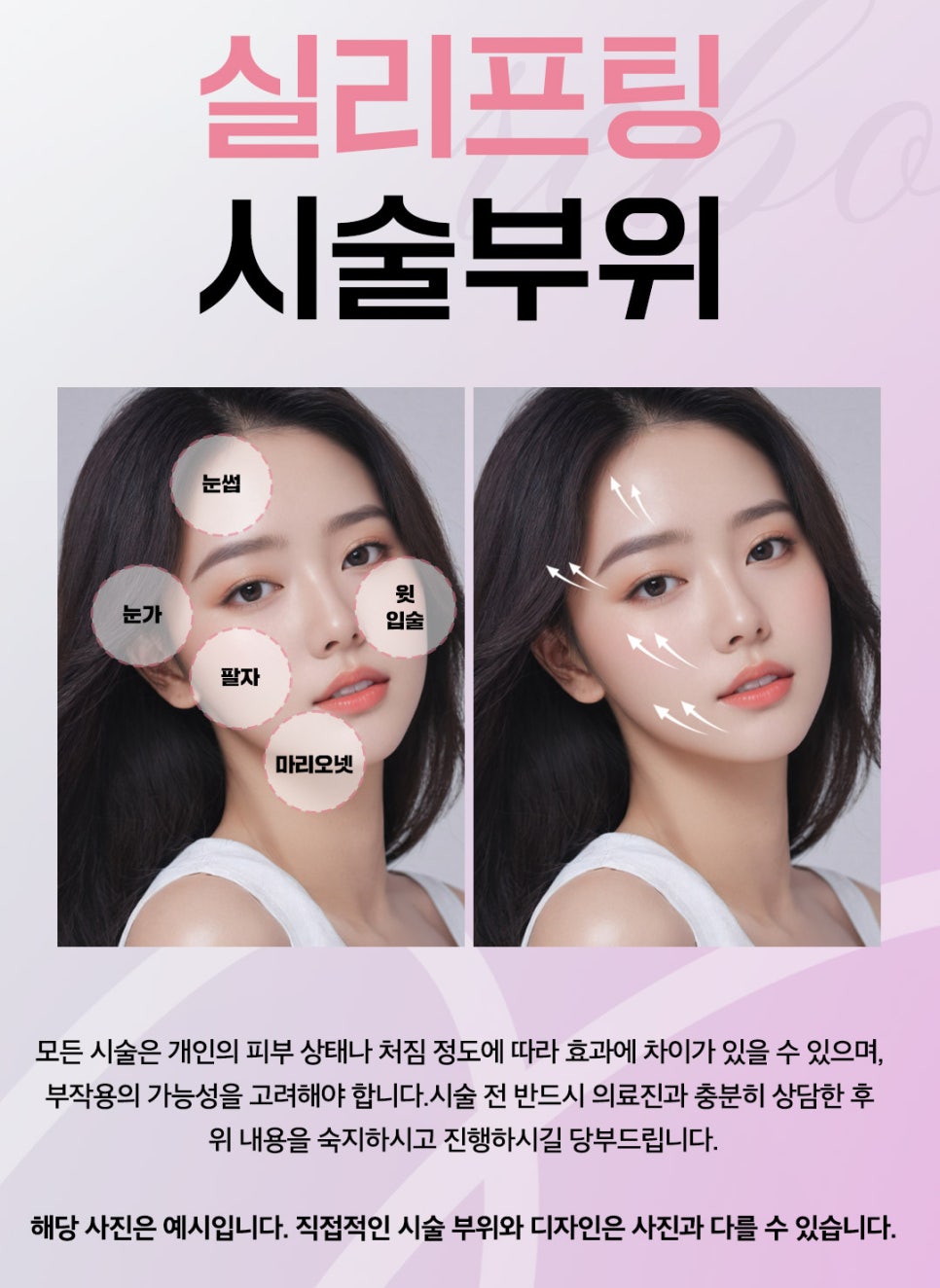 실리프팅 끊어짐? 시술 후 뚝 소리? 걱정하지 않으셔도 됩니다. 관련 이미지 1