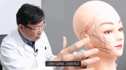 Please Read This If You’re Worried About Cheekbone Enlargement After Thread Lifting image 2