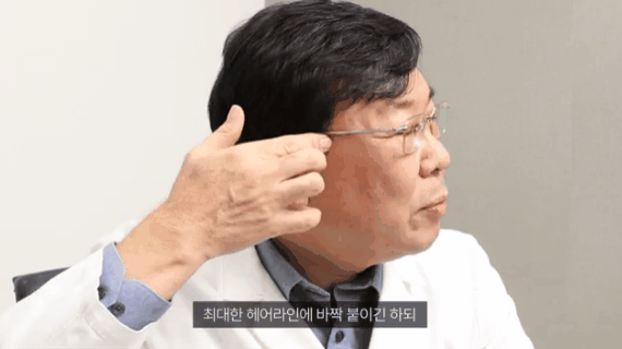 Why a Midface Lift Review Shows That a Facelift May Not Be Necessary image 1
