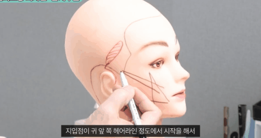 If You’re Looking for Facelift Results, Thread Lifting May Be the First Step. image 1