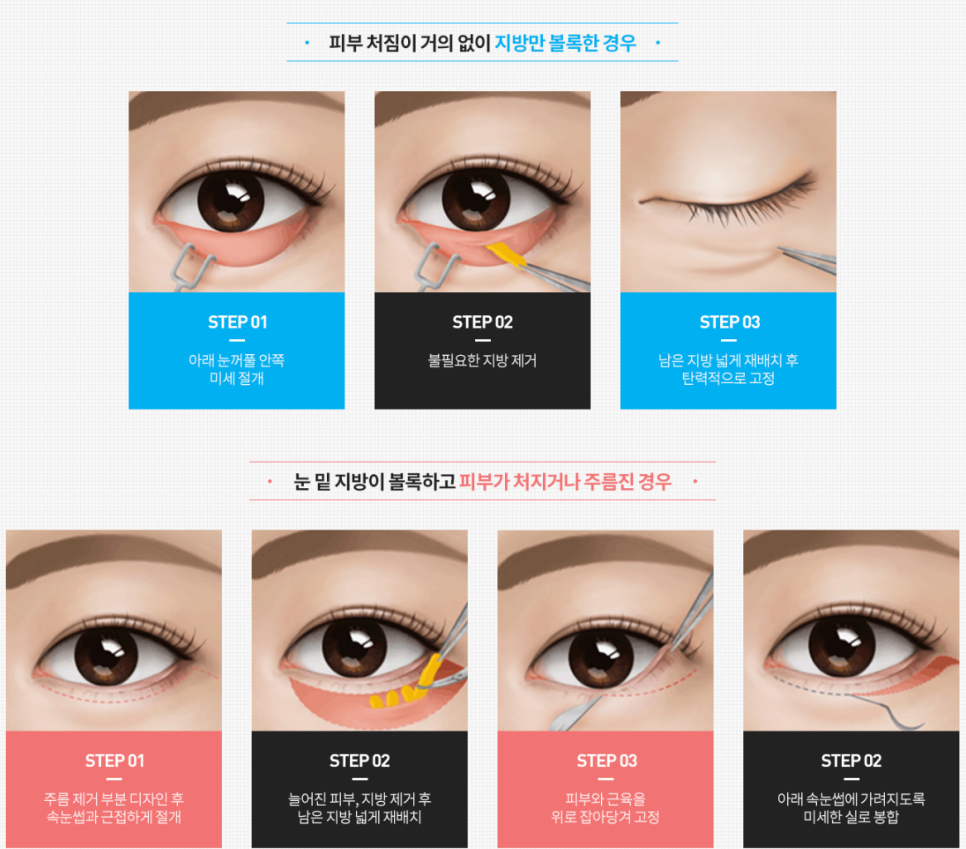 신사 중년눈성형 후기 처진눈을 올려라! 관련 이미지 5