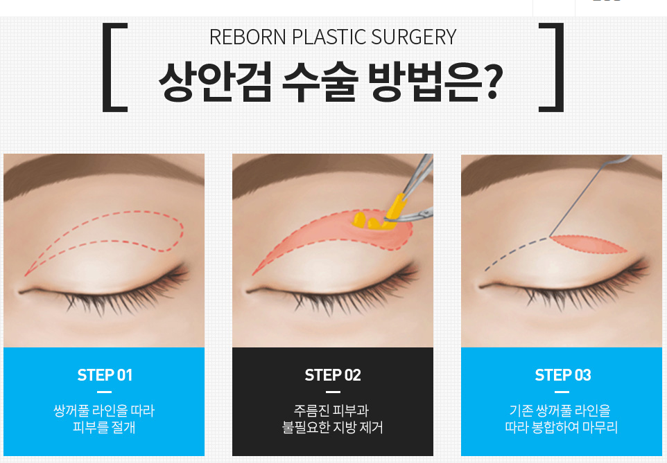 신사 중년눈성형 후기 처진눈을 올려라! 관련 이미지 4