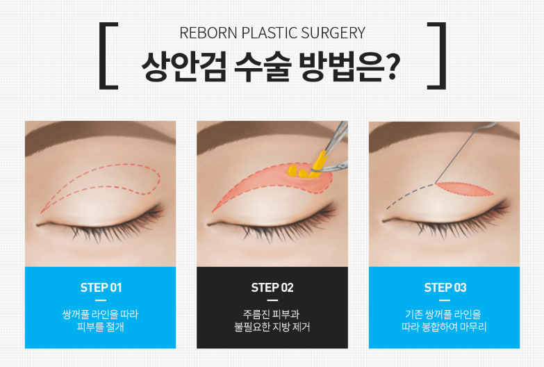 상안검하안검 후기 말고 관련 이미지 1