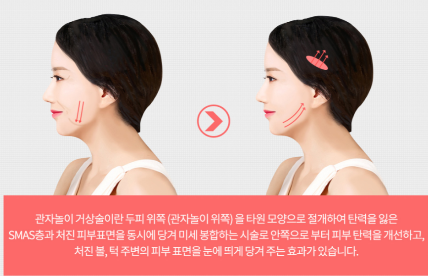 A Plastic Surgery Clinic Good at Facelift Surgery? The Reason for Lifting the OOOO image 4