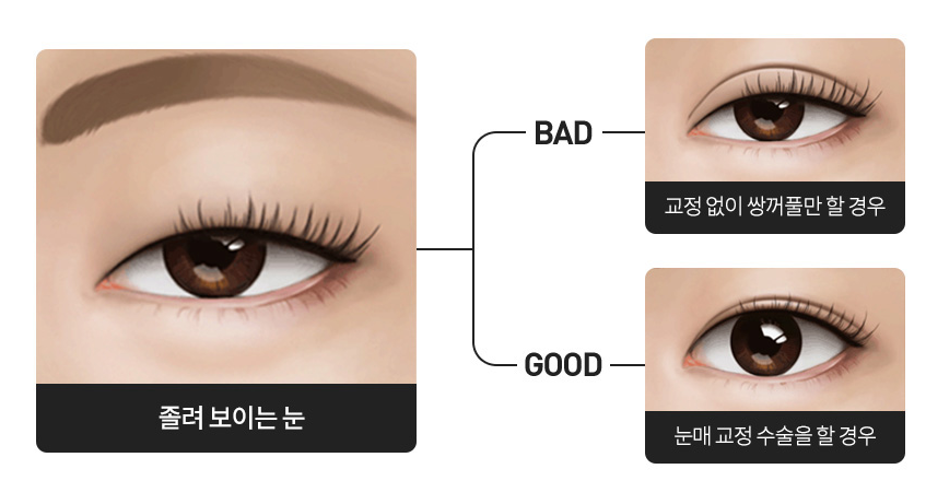 눈매교정전후 망하기 싫어 발품 팔다보면! 관련 이미지 4