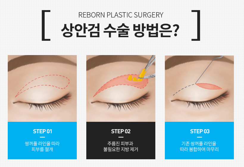 중년 처진 눈 성형 수술 가격, 비용 궁금한 부분에 대해서 관련 이미지 2