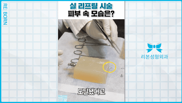 중안면거상술 수술 붓기 흉터 부담된다면 관련 이미지 2