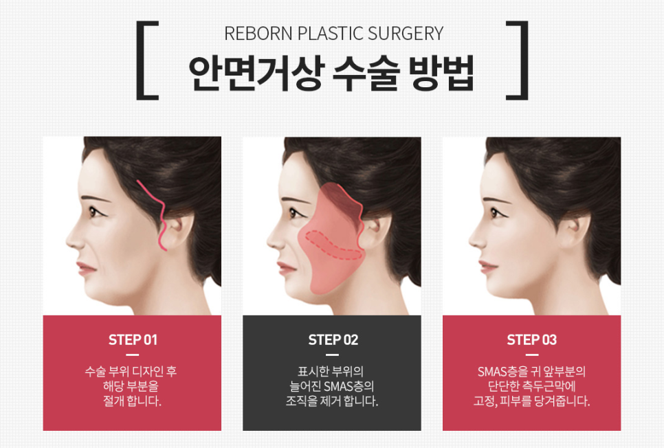 강남 안면거상술 후기, 얼굴 전반적 처짐개선에 효과적 관련 이미지 1