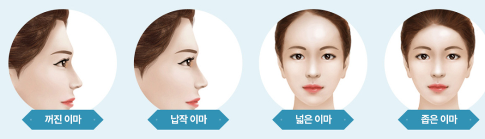 이마성형 어디서 부터 알아봐야 할까? 관련 이미지 3