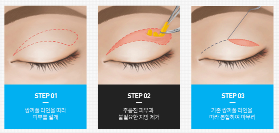 Midlife Eye Surgery Price, Is Cost Really Important? image 2