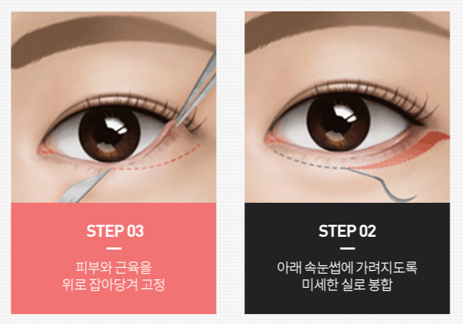 Midlife Eye Surgery Price, Is Cost Really Important? image 4
