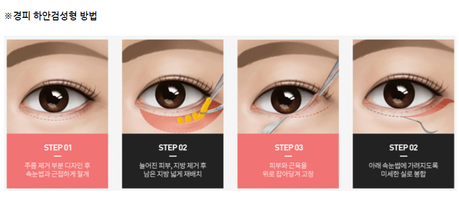 신논현 성형외과? 중년눈성형, 상안검/하안검 최종 정리하세요. 관련 이미지 4