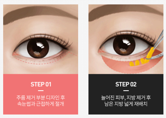 Why Searching for Before-and-After Photos of Upper and Lower Blepharoplasty Is Pointless image 4