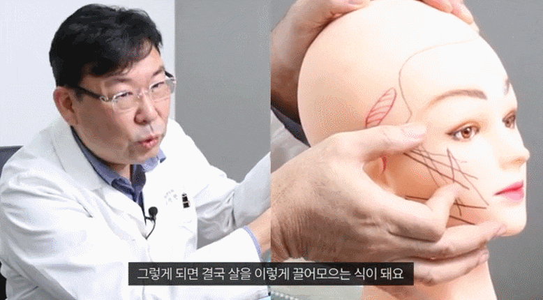 If you're concerned about how long results last before looking for a plastic surgery clinic for mini facelift surgery image 1