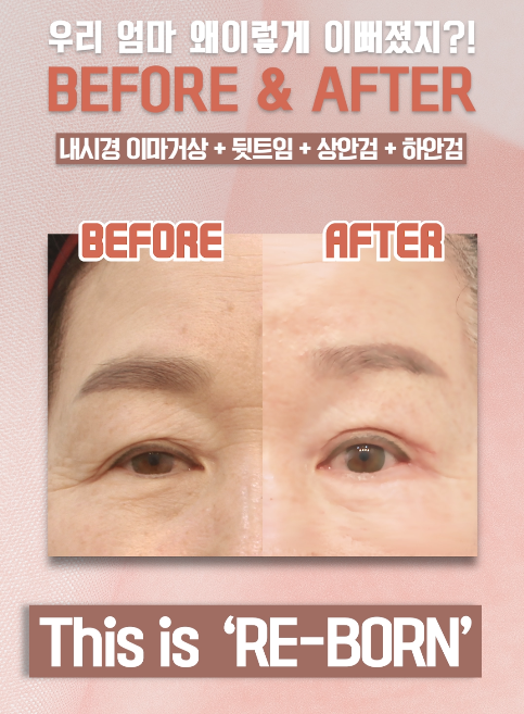 Middle-aged Eye Surgery Review, for Those Looking for Places with Many Before-and-After Photos! image 1