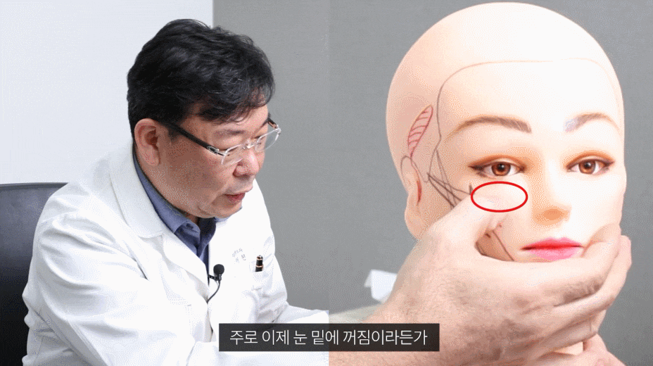 미니안면거상성형? 늘어진 눈가, 광대살 함께 개선하고 싶은 분들께 관련 이미지 4
