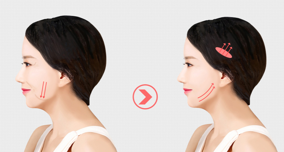 쓰리스텝 관자거상 실리프팅과 병행하면 좋은 이유 정리합니다. 관련 이미지 4