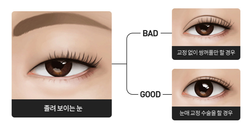 신논현역 눈매교정 잘하는 성형외과 찾기 전 필독해주세요. 관련 이미지 4