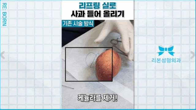 신사성형외과 실리프팅 잘하는곳 찾는 분들에게... 관련 이미지 1