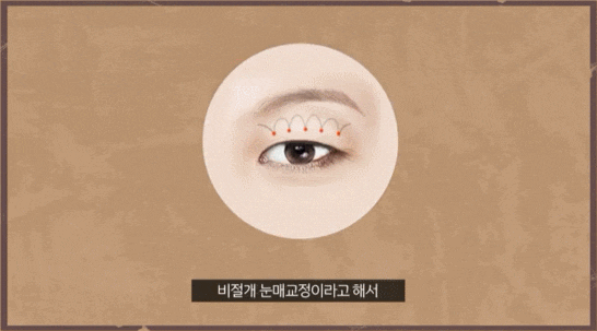 졸린 눈 수술 눈매교정? 쌍수? 어떤 걸 해야 할까 관련 이미지 2
