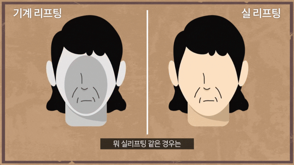 마리오네트 시술 실리프팅 받기 전 필독해 주세요 관련 이미지 2