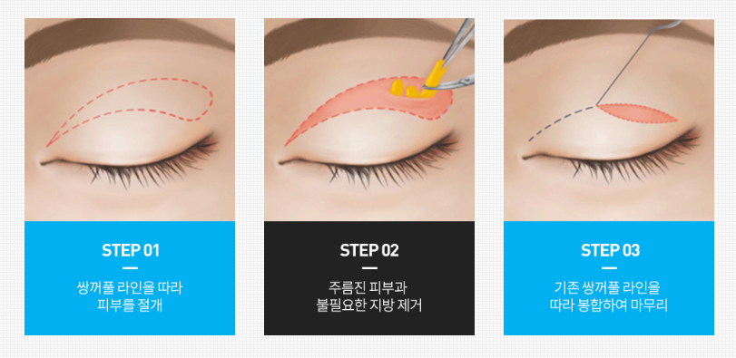 Middle-aged Eye Surgery Review, for Those Looking for Places with Many Before-and-After Photos! image 2