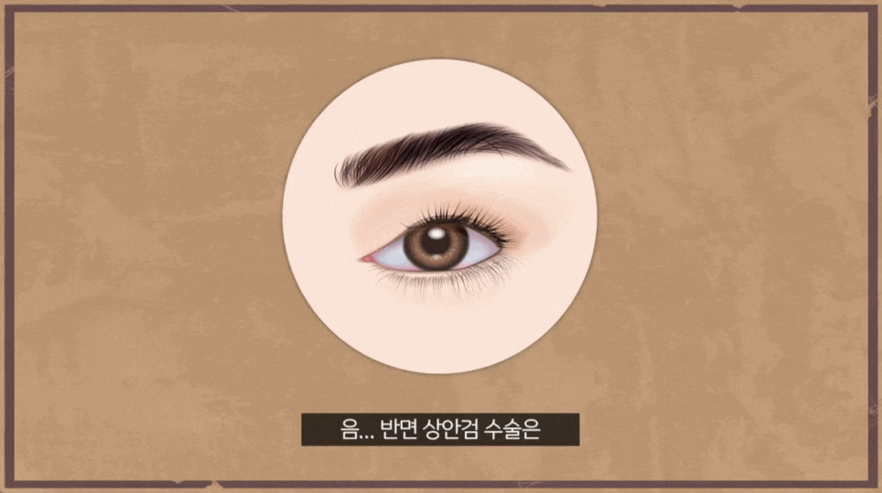 상안검 수술 성형외과 찾을 때 이것을 꼭 확인하세요. 관련 이미지 6