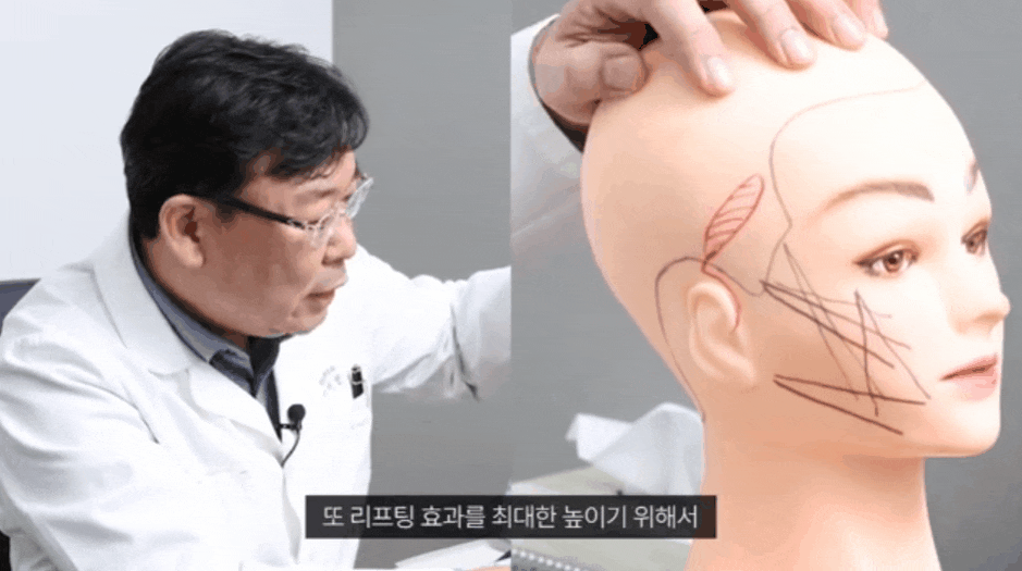 Sinsa-dong Thread Lifting Prices: What Else Should You Check Besides the Cost? image 4