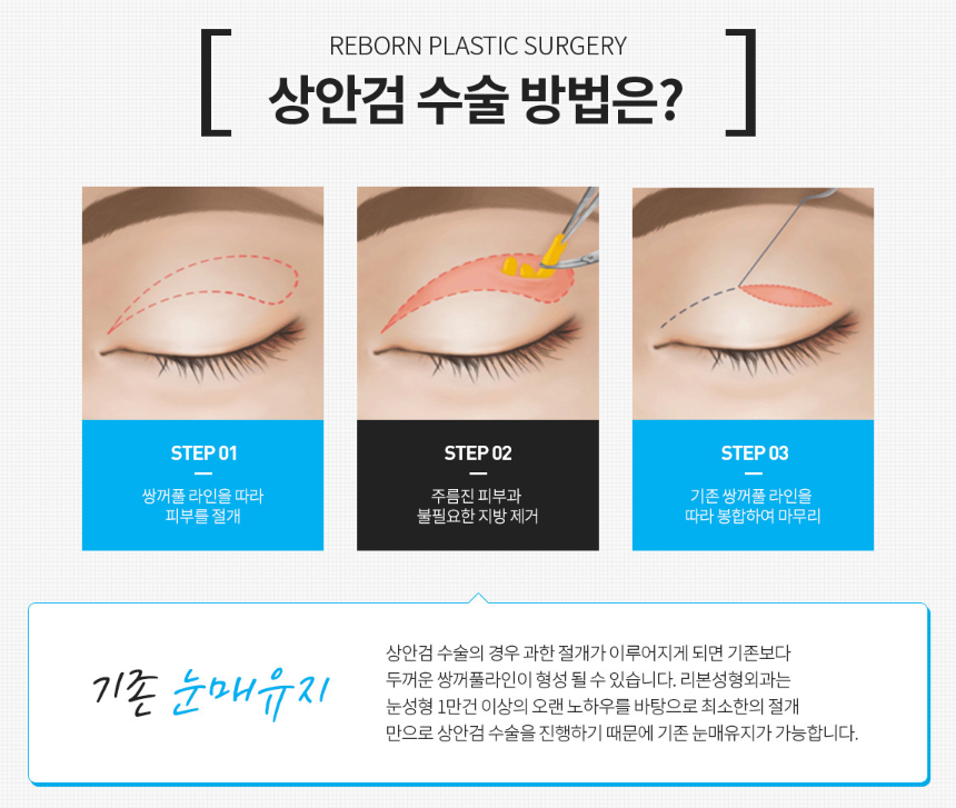 신사 상안검수술 처진눈성형 실패하지 않으려면 필독해주세요 관련 이미지 2