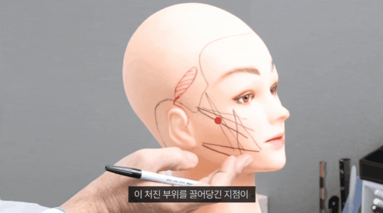 What Causes Sagging Skin and Wrinkles, and How Effective Is Thread Lifting? image 4