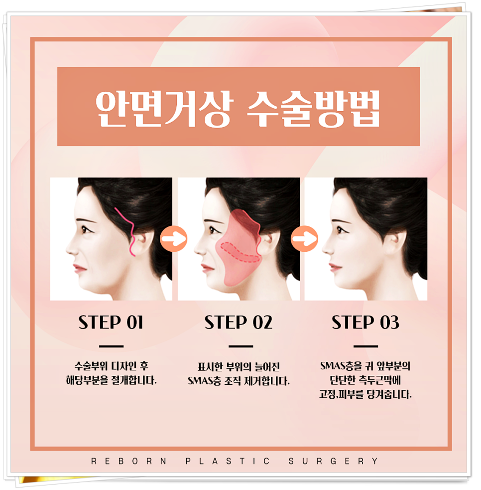 주름과 탄력 그리고 리프팅까지 한번에 해결, 리본의 안면거상! 관련 이미지 3