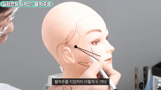 신사역 실리프팅 잘하는곳 광대부각, 딤플현상 등 걱정된다면 관련 이미지 1
