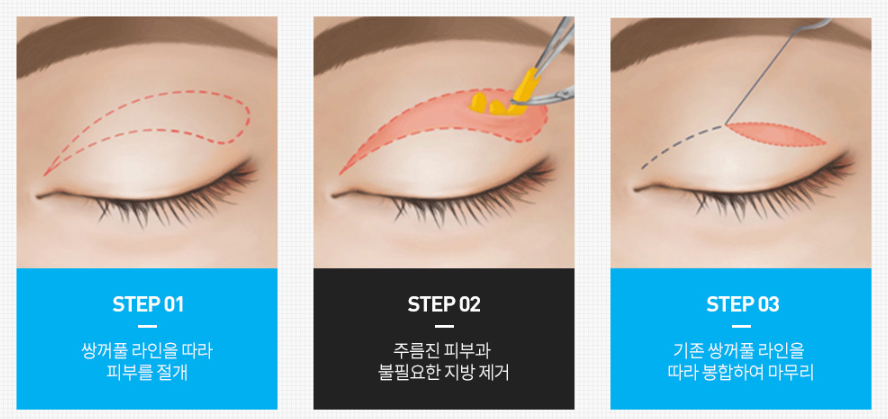 상안검/하안검수술 비용 부담스럽지 않은 결과 얻으려면? 관련 이미지 5