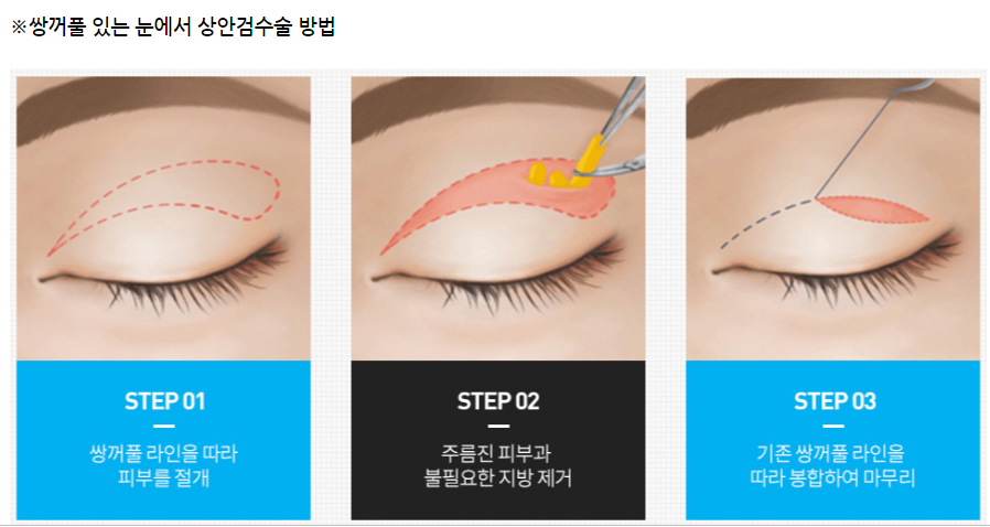 신논현 성형외과? 중년눈성형, 상안검/하안검 최종 정리하세요. 관련 이미지 2