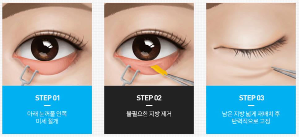 신논현성형외과? 상안검, 하안검 관련 이미지 3