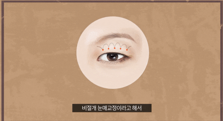 절개 비절개 눈매교정 수술 방법의 차이점에 대해 안내합니다 관련 이미지 4
