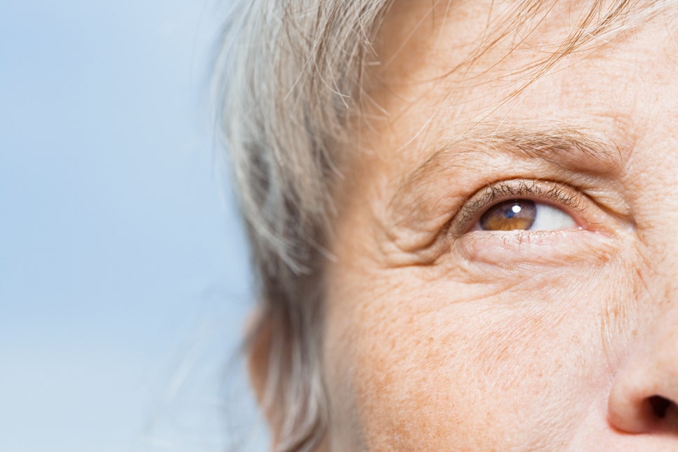 Before and After Photos of Middle-Aged Eye Surgery: Learn the Differences from Regular Eye Surgery First image 4