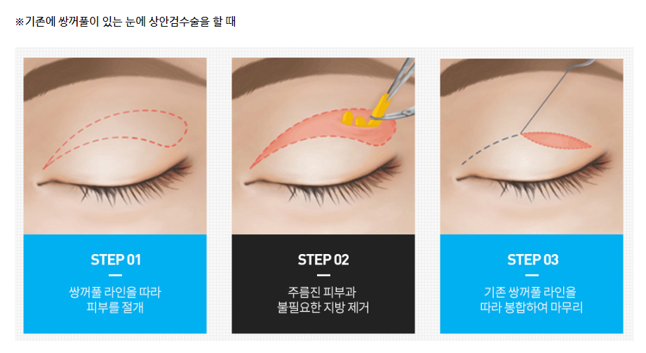 상안검하안검수술 부작용 걱정된다면 이 글을 필독해주세요 관련 이미지 4