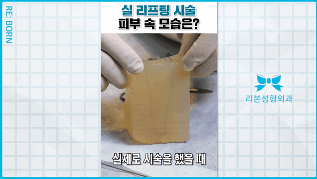 중안면거상술 수술 붓기 흉터 부담된다면 관련 이미지 4