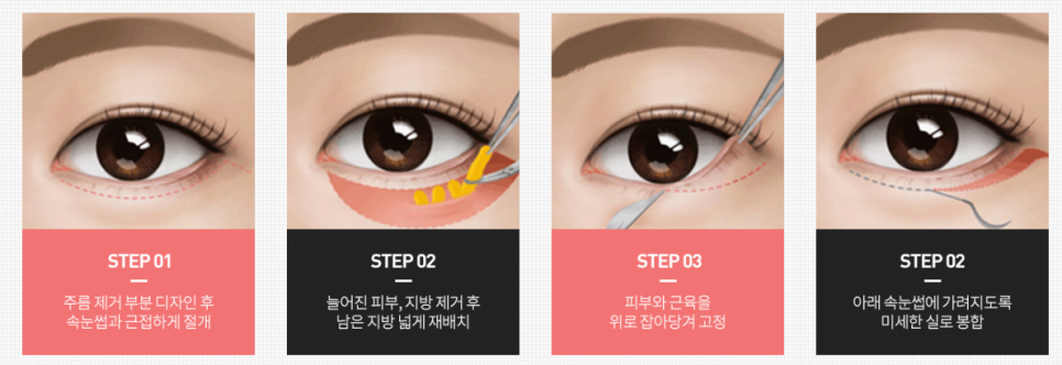 신사동눈성형 상안검하안검 수술 받기 전 필독해주세요. 관련 이미지 4