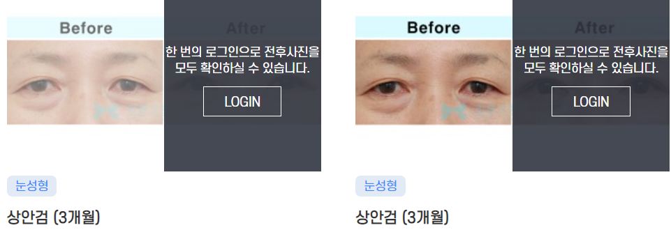 Apgujeong Middle-Aged Eye Surgery: Refined and Elegant image 2