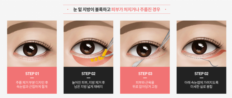 하안검수술후기 전후사진 잘 살펴보고 수술 결정하세요 관련 이미지 3