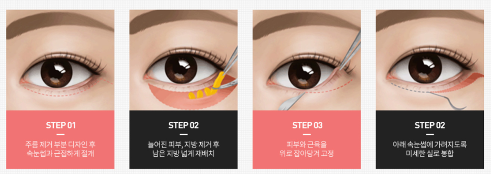 상안검/하안검수술 비용 부담스럽지 않은 결과 얻으려면? 관련 이미지 6
