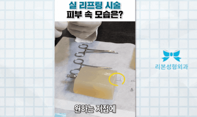신사동 실리프팅 잘하는곳 찾는 분들은 필독하세요 관련 이미지 3