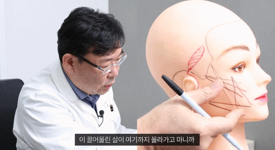 Facelift Surgery Recovery and Scars: What I’d Like to Explain image 3