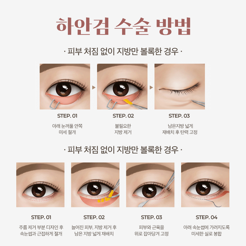 강남역성형외과 눈 밑 주름, 애교살로! 관련 이미지 3