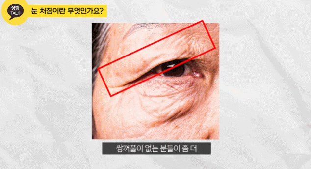 상안검성형외과 유명한곳? 이유가 따로 있습니다. 관련 이미지 4