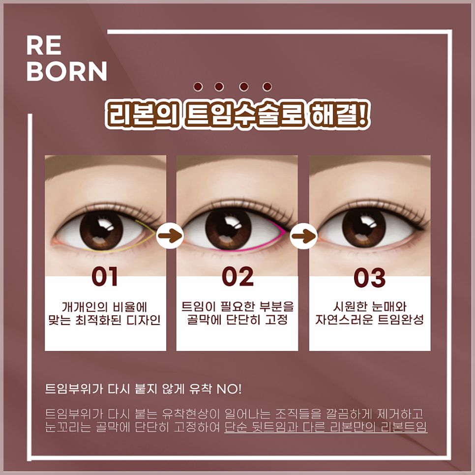혹시 시원하고 큰 눈매원해? 그럼 눈트임수술/성형이지! 관련 이미지 3